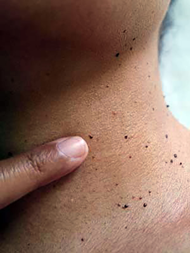 skin tag removal newcastle